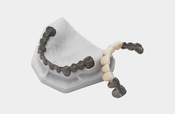 Metal 3D Printed Dental Bridges